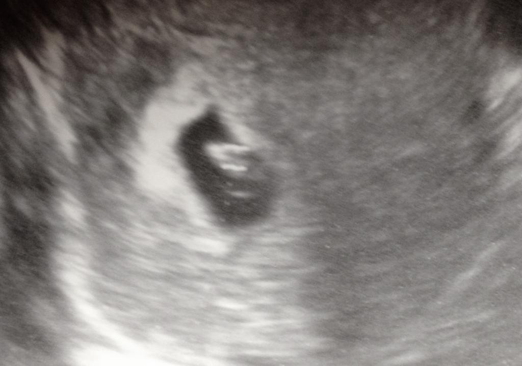 Ultrasound number 2